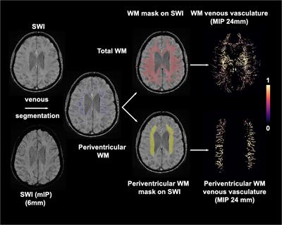 Reduced white matter venous density on MRI is associated with neurodegeneration and cognitive impairment in the elderly